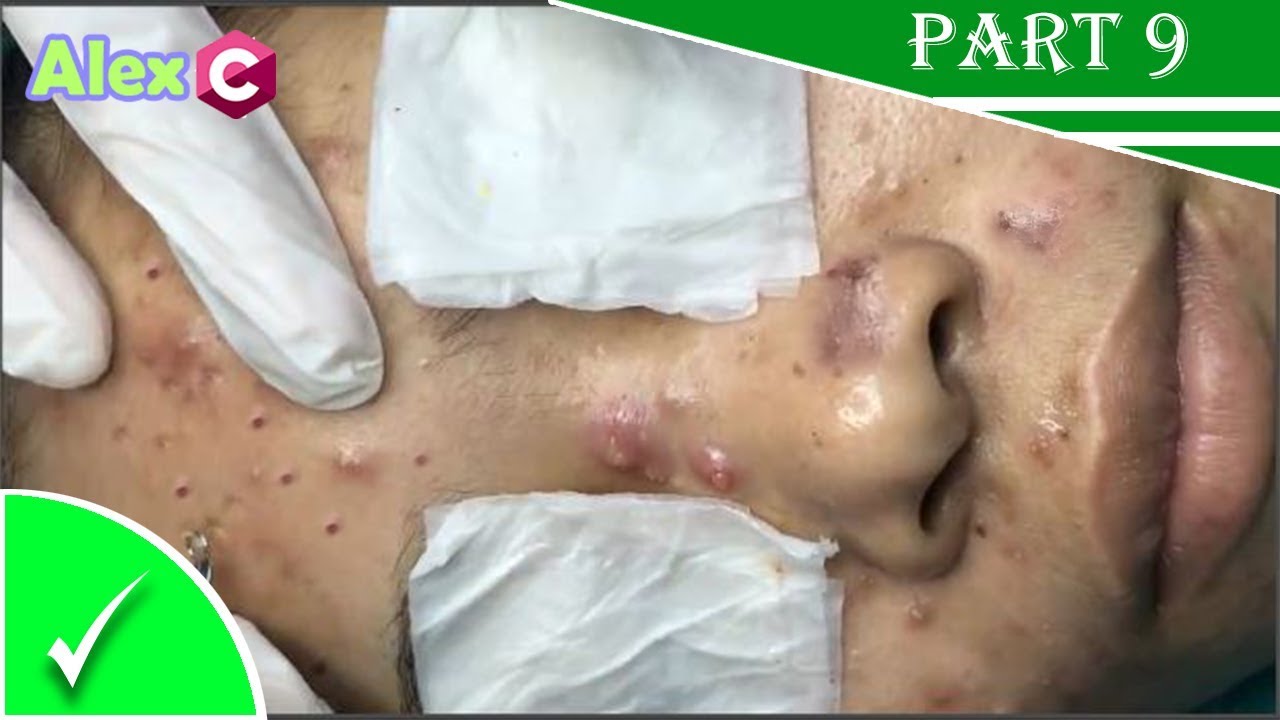 How To Removal Big Pimple Popping Cystic Acne Extraction Skincare Fda Video Blackhead Popping