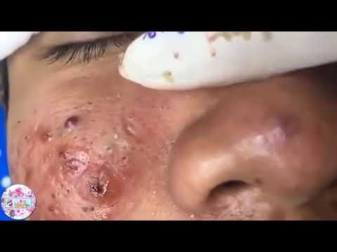 Worst Case Removal Blackheads On The Face How To Remove Blackheads By ...