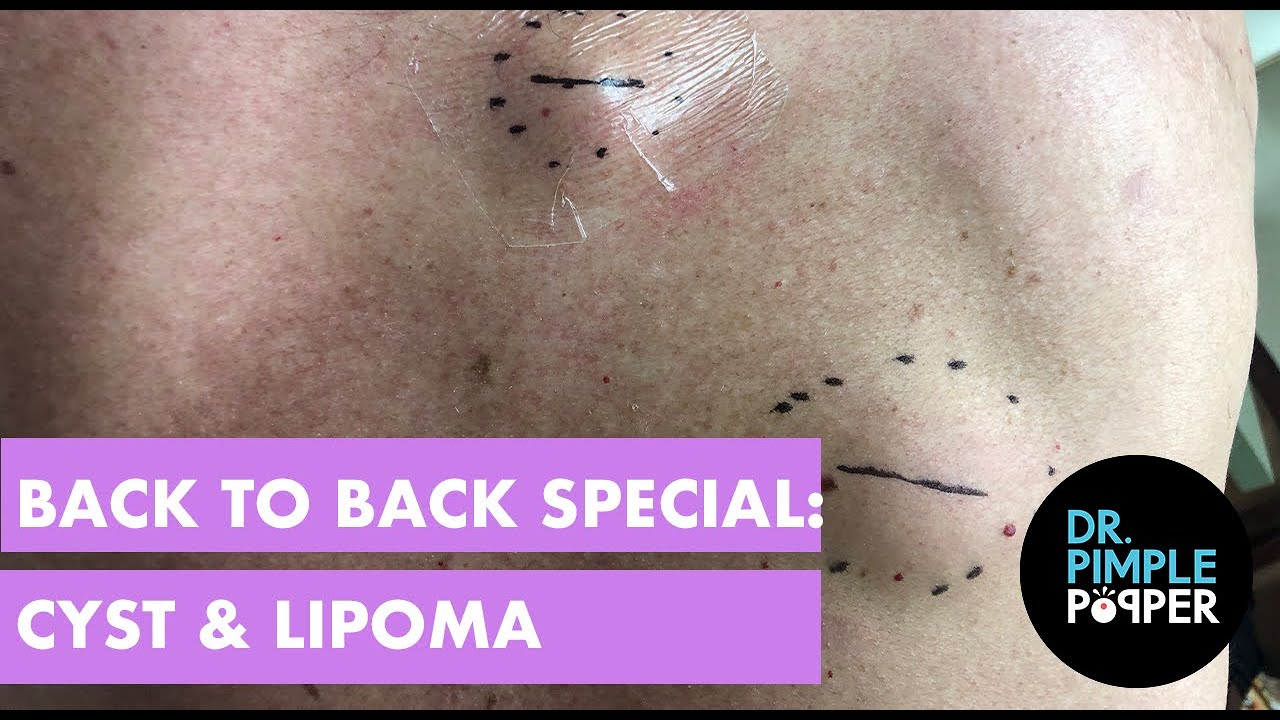 Back To Back Special Lipoma And Cyst Blackhead Popping