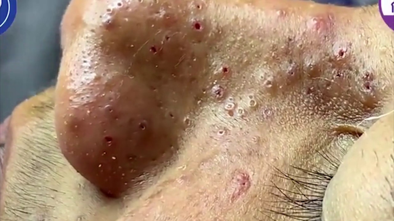 Acneextraction Pimple Popping Blackheads Removing Compilation Blackhead Popping