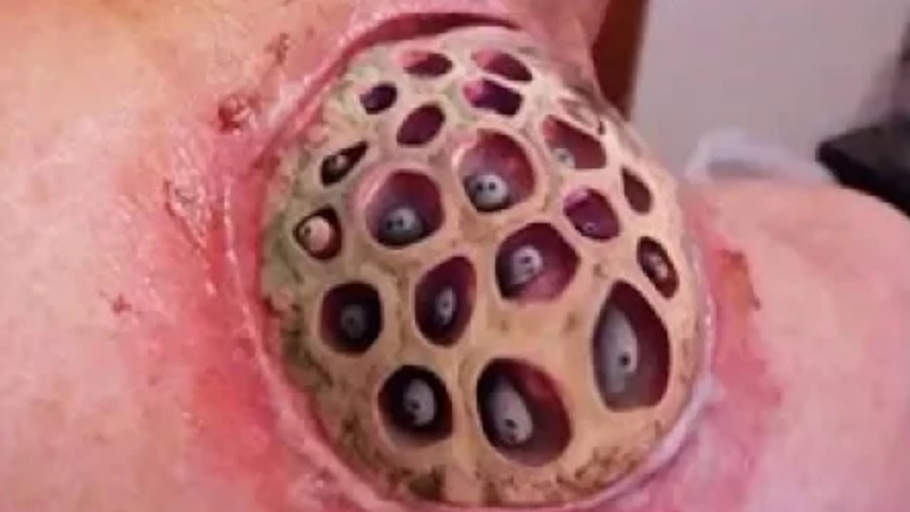 massive pimple pop