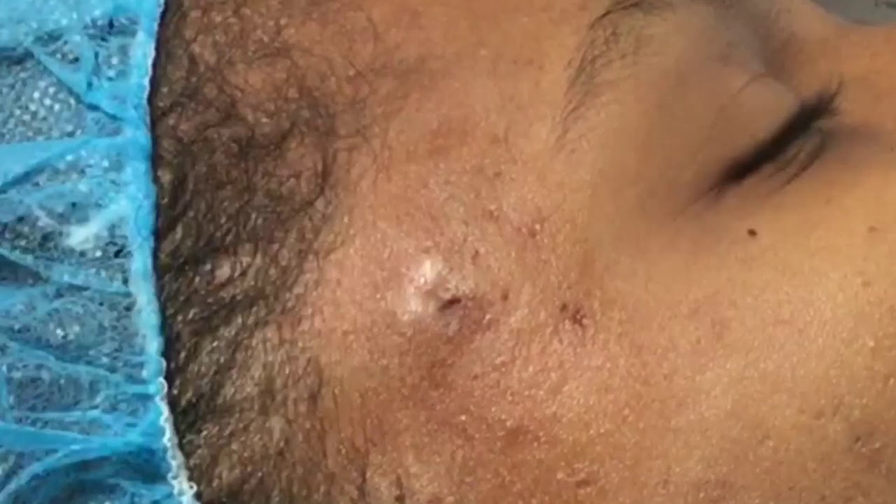 Cyst Removal New Client - blackhead popping